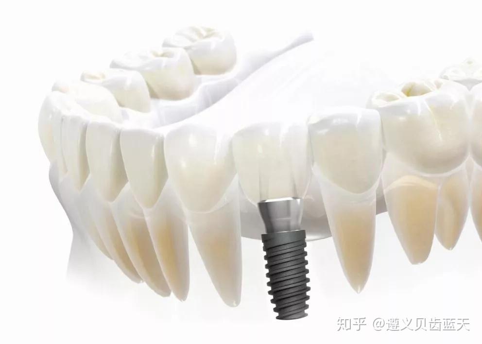 最新牙冠种类概览与观点论述